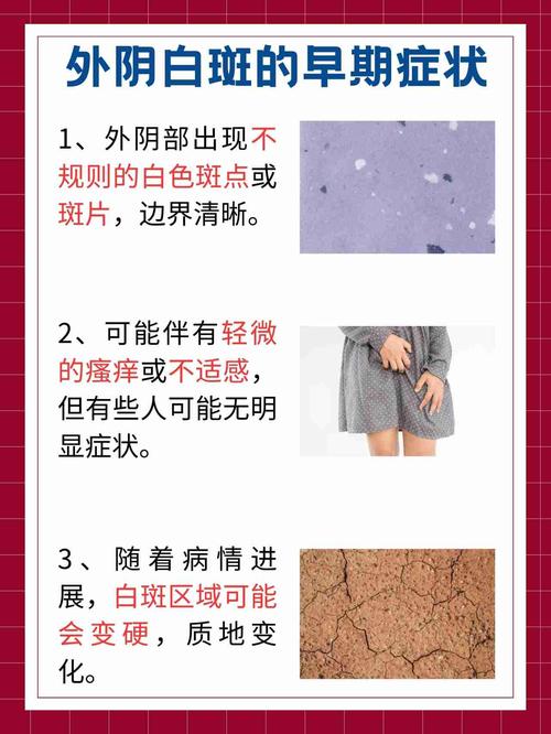 妇科白斑病严重吗-妇科白斑病能根治吗