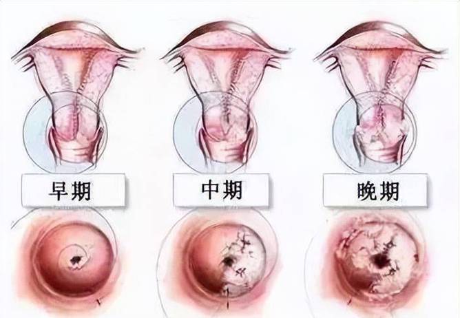 宫颈消退50%-宫颈消退50%是什么意思