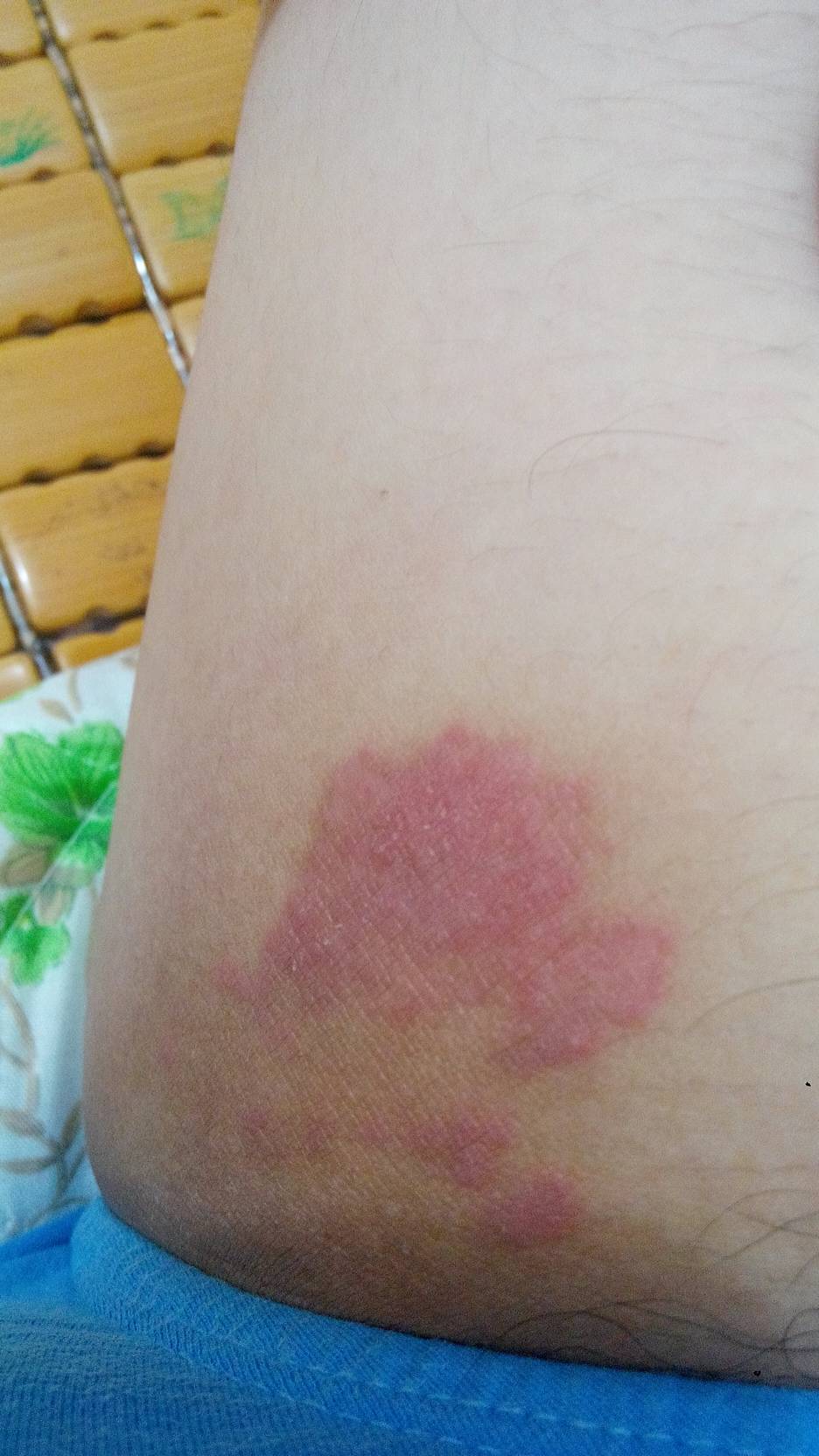 大腿根部很痒还有包,大腿根部很痒还有包块怎么办